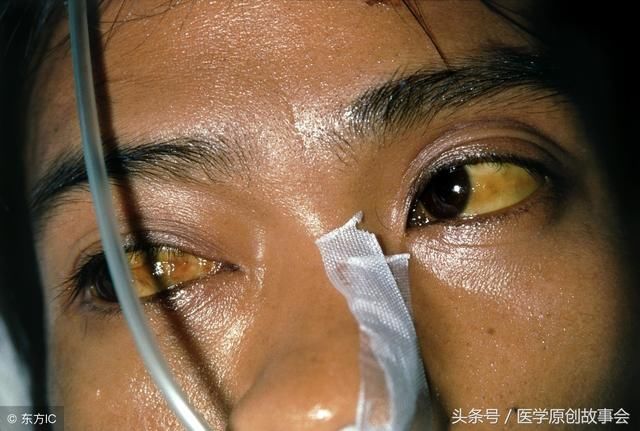 27岁男子皮肤发黄,告诉医生天天喝白酒,十天后