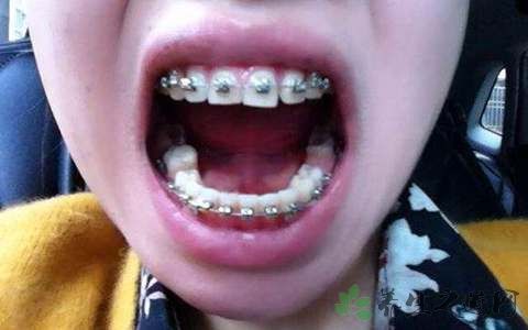 龅牙带牙套的危害