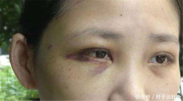 女子哺乳期被丈夫家暴 月子期间被打4次 6个月