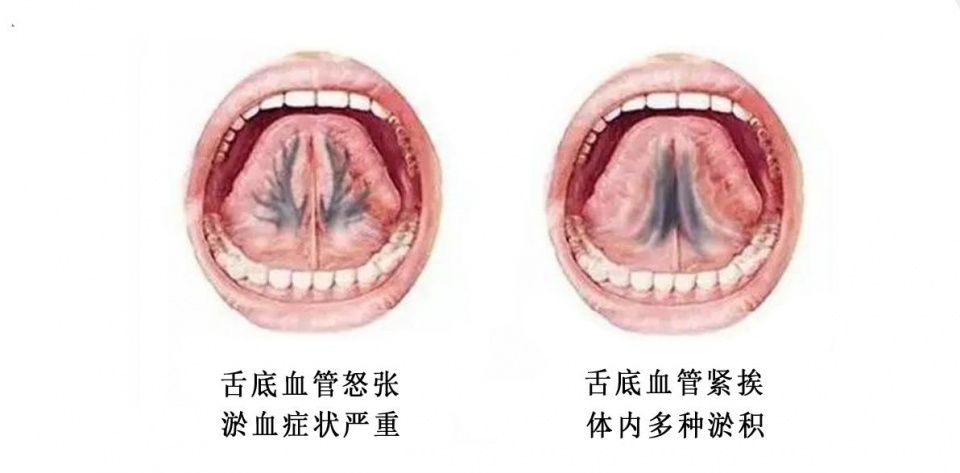 神奇的杨氏微排栓,舌下取栓排毒还原传统疗法