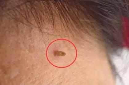 脖子上长了这几个小东西, 很可能是癌症的早起