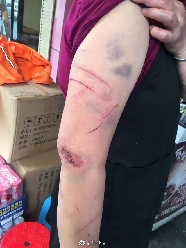 网传疑似牛琴的婆婆被打伤胳膊的图片