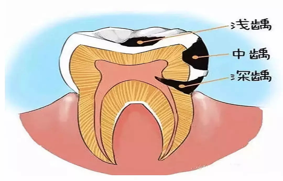 龋齿也是癌症的引路人!一颗"虫牙"这样悄悄伤害你