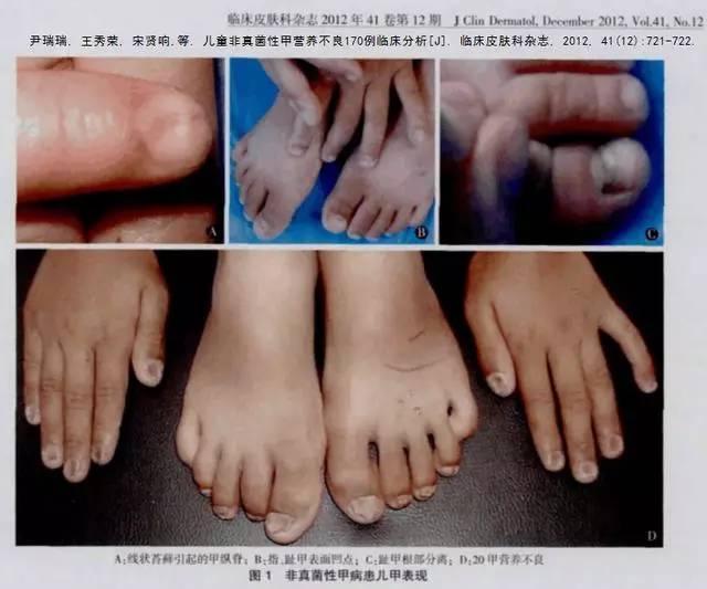 这可不是灰指甲,是甲营养不良!