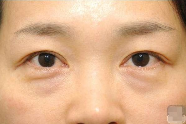 女人长眼袋就要打玻尿酸?别傻了!涂点厨房便宜