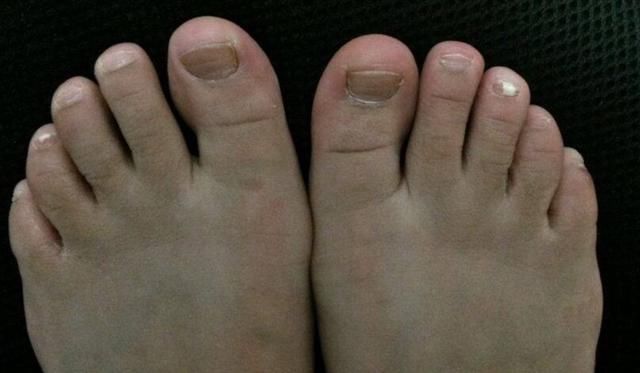 五,脚指甲生长变得缓慢 人体的最末端的地方,莫过于脚趾了,如果你