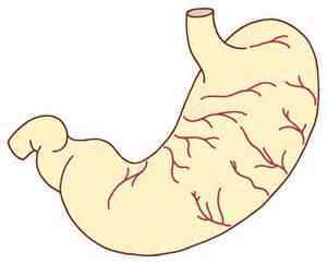 慢性非萎缩性胃炎伴胆汁反流症状