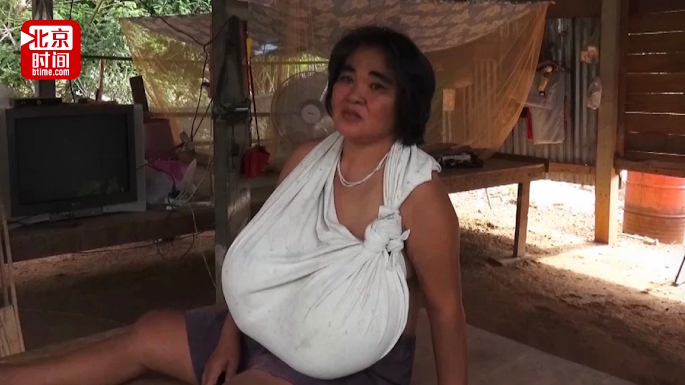 胸大也是病！泰国女子胸部疯长到无法行走只剩一件衣服能穿下