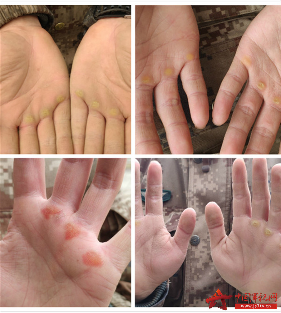 这些老茧平平无奇,如果没有特殊注明的话,你甚至都不会知道这些手的