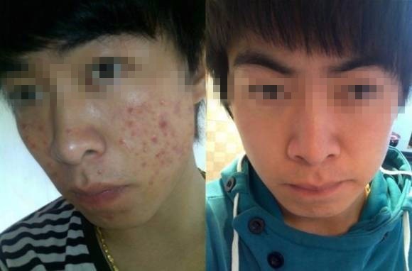 青少年青春痘怎么治?脓包型痘痘的治疗的方法