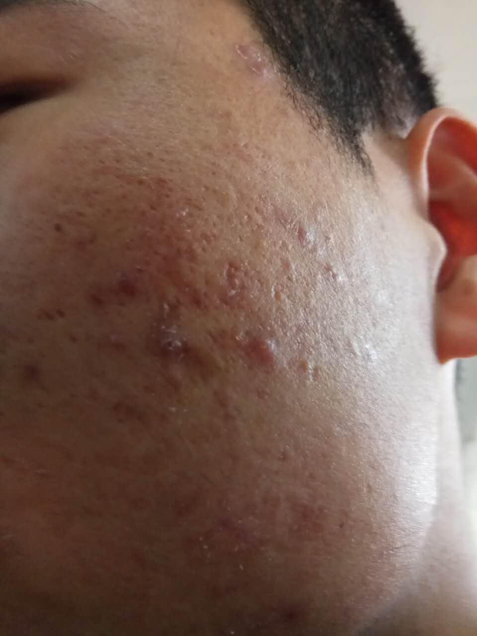 脸上又长了一颗痘痘!