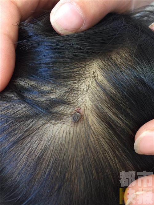 心疼!西安一两岁女童被蜱虫咬头皮 家长紧求医