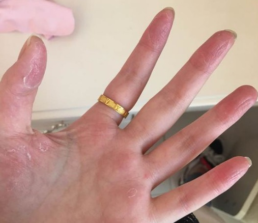 手湿疹症状,难道你还不知道吗