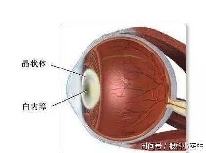 新生血管性青光眼