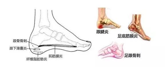 足跟痛得下不了床?农村一种树枝,一用一个好,