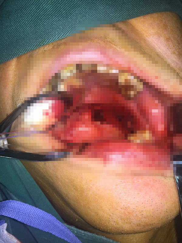 吃饭咬到舌头引发溃疡 一个月后竟诱发舌癌!