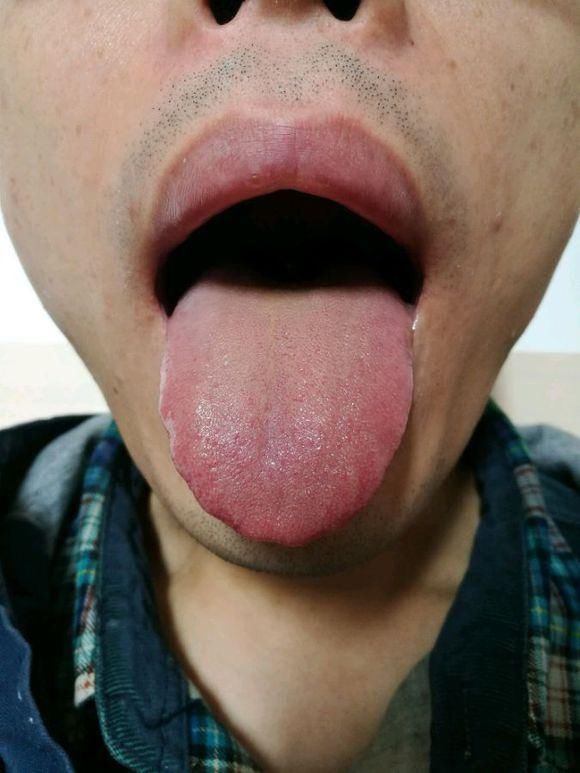 珍贵舌诊:脾肾阳虚、阴虚内热、脾胃湿寒的舌