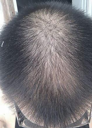 5年脂溢性脱发,用这个偏方只需7天,全部治好了