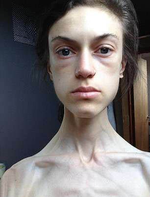 22岁女子减肥过度,只有32公斤随时会死掉,治愈后让人不敢相信