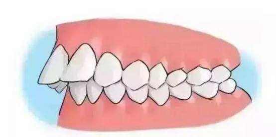 口腔矫正相当于整容 牙齿不齐的你还不过来看