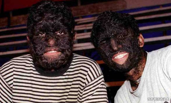 有的人身上毛发太多无法控制时,称为多毛症,患有这种疾病的患者通常