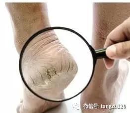 史上最全科普:糖尿病足的临床表现及分级