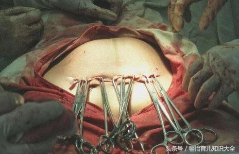 48岁产妇超预产14天未发动,医生紧急剖开肚子,一股恶臭扑面而来