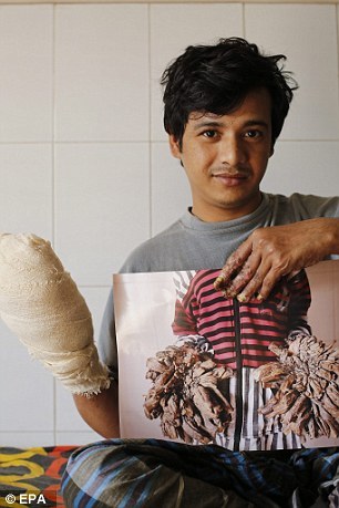 孟加拉国达卡医学院附属医院专门成立了一个医疗委员会，为他制定治疗计划。经过16次手术，长达近一年的治疗，医生为他去除了大约10斤的枝状疣。