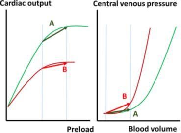 中心静脉压(CVP)可以作为液体复苏的风向标吗