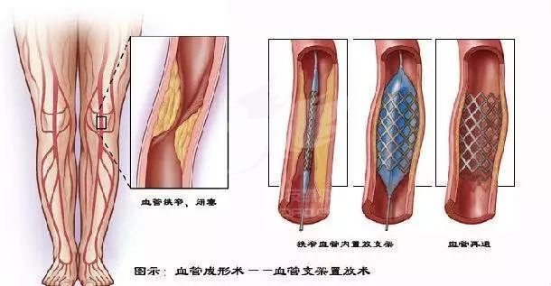 血管堵塞,医生是用这个方法恢复通畅的,3D动画