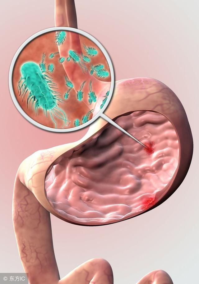 好身体出现四种异样 表明你已被幽门螺杆菌传染