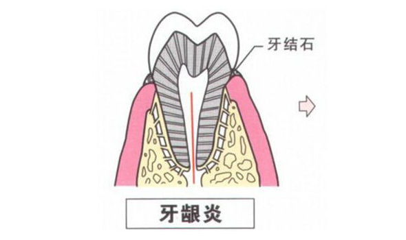 牙龈出血选用什么牙膏好?-北京时间