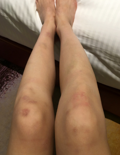 沈梦辰这次不露香肩了 改秀伤痕累累的双腿