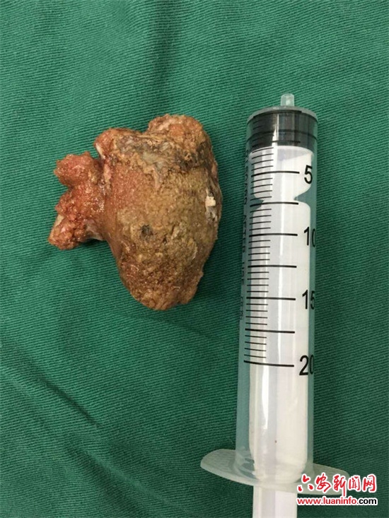 市四院泌尿外科自主完成腔镜下肾脏巨大结石取