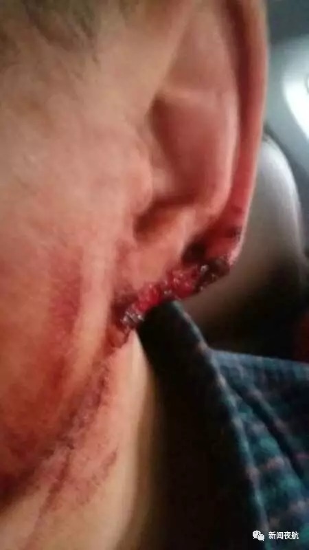 哈尔滨男子养狗扰民 邻居与其争论未果被咬掉耳垂 哈尔滨男子养狗扰民 邻居与其争论未果被咬掉耳垂