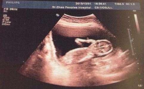 孕妈了解胎儿性别,就看B超单上的4个字和图像