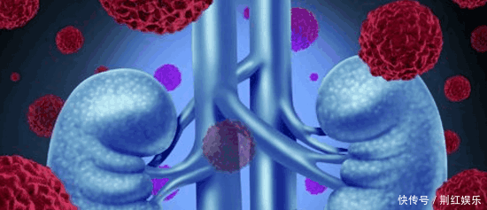 25岁男子患尿毒症, 换肾后能活多久