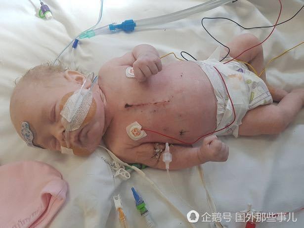 女婴出生时仅有半颗心 手术后奇迹存活