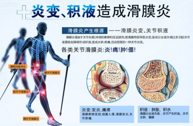 滑膜炎危害大,治疗和日常保养也很重要