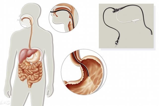 这种呼气实验轻轻吹气就能检查胃病,真的可以