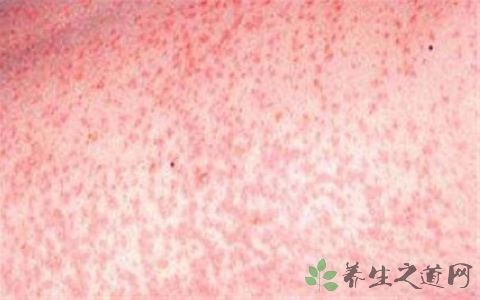 梅毒疹会反复发作吗