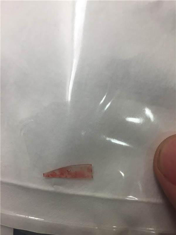 男子手臂突出一个包包,去医院检查竟然取出这