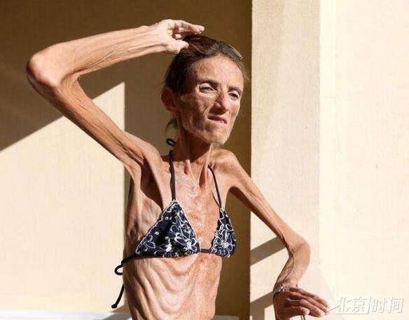 女子减肥过度瘦成骷髅人 那么漂亮的她回不去了