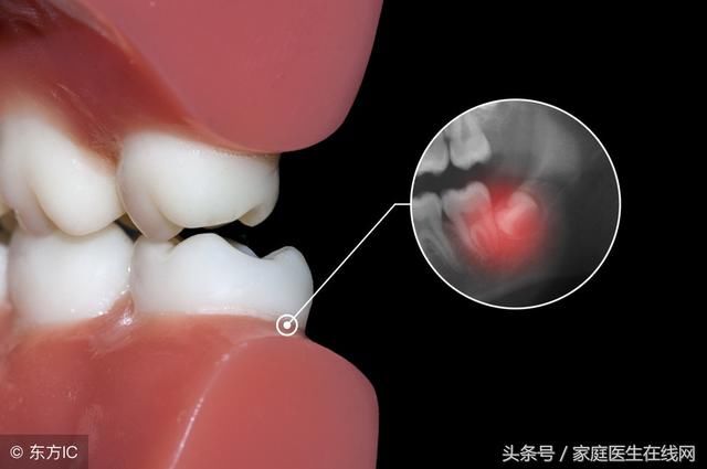 智齿不痛不痒有什么用,是不是不用拔掉?快听医