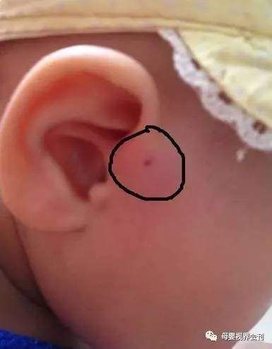 你家宝宝耳朵上有这种小孔吗?如果有,就要小心