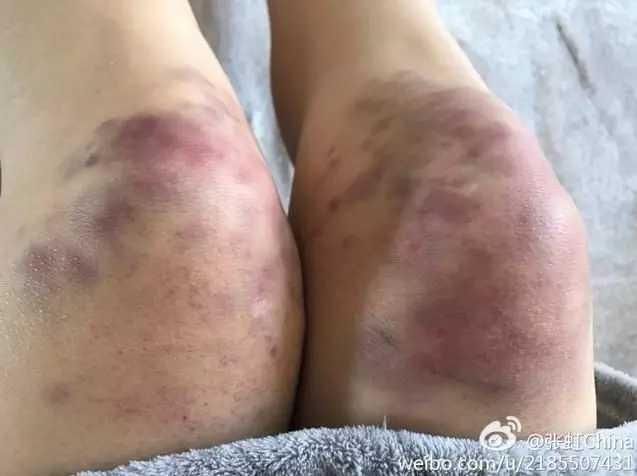 反手摸肚脐的奥运冠军女神,双膝红肿令人心疼,年近30仍单身