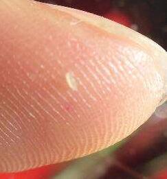 毛孔里白色的颗粒是什么?不只是油脂还有活物