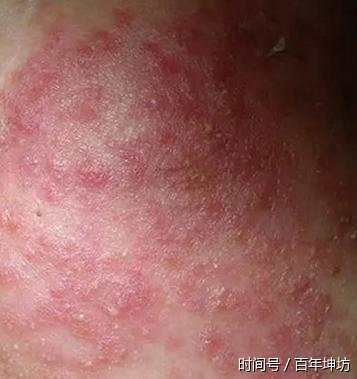 激素脸排毒症状有哪些?