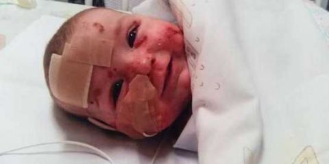 女孩患罕见病被称为蝴蝶宝宝 身体一碰就出水