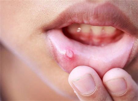 积极消除病因,并使用药物治疗(一般来说,可以适用锡类散,冰硼散或是用